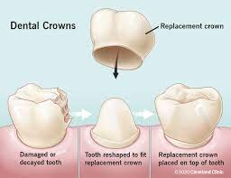 illustration of crown capping off tooth, Douglasville, GA crowns