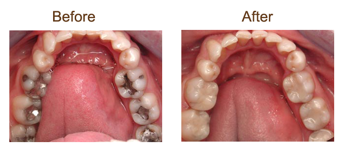 TOOTH COLOR FILLINGS